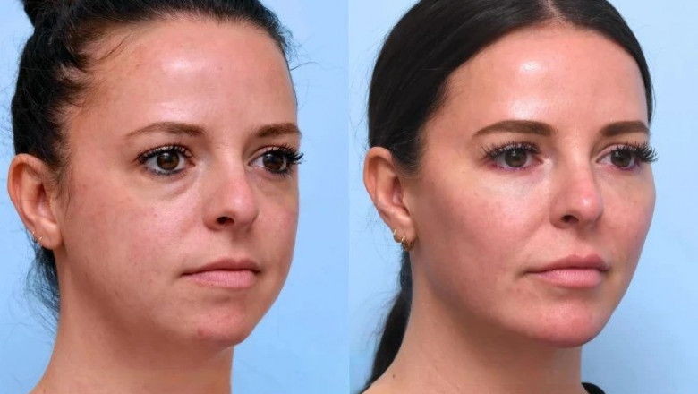 Thread Lift vs. Traditional Facelift: What the Best Doctors in Dubai Want You to Know