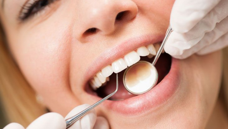 Tips to Get the Best Deal on Teeth Cleaning in Dubai