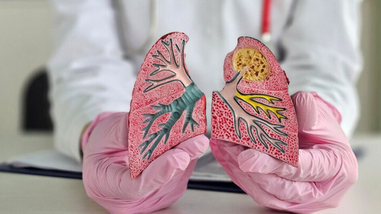 Tuberculosis: Symptoms, Causes, and Treatment Options