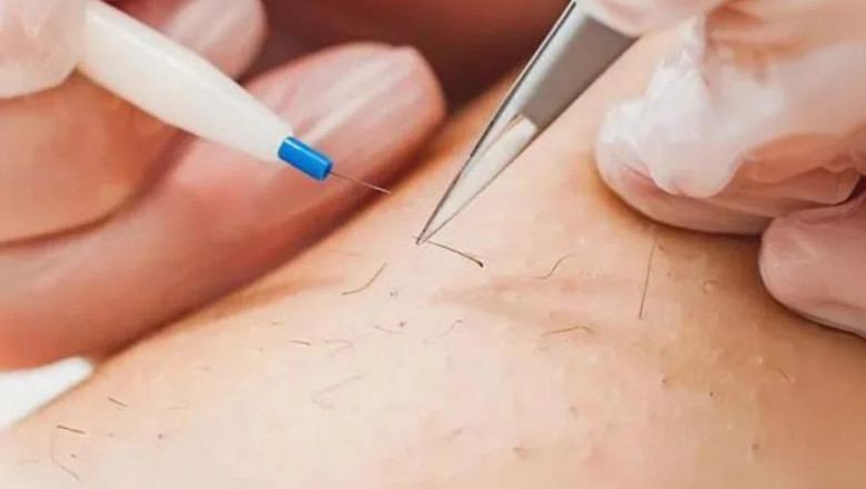 Benefits of Electrolysis Laser Hair Removal