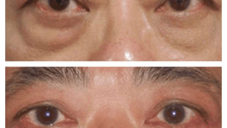 Can You Do Eye bag removal in Dubai During Pregnancy?
