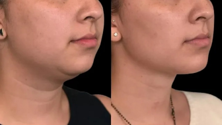 Future Innovations in Double chin removal in Dubai