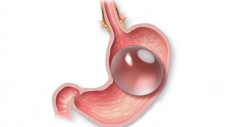 How gastric balloon placement helps weight loss
