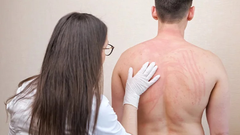 Stevens-Johnson Syndrome Attorneys in Georgia