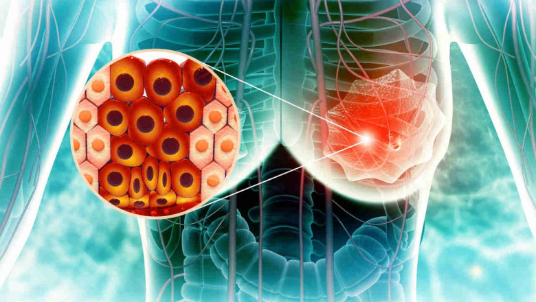 A Game-Changer in Oncology: Explore Targeted Therapy for Cancer in Delhi