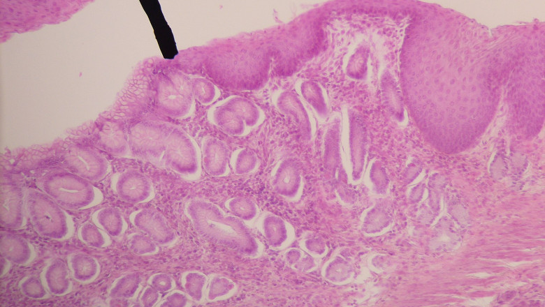 Advanced Non-Squamous and Squamous NSCLC Market is Anticipated to Witness High Growth Owing to Rising Adoption of Targeted Therapies