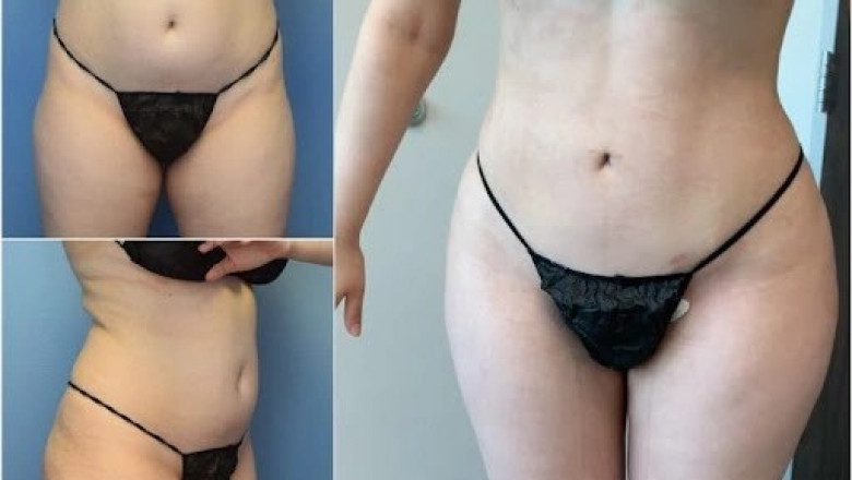 Beyond Recovery Unlocking the Best Liposuction Results in Dubai