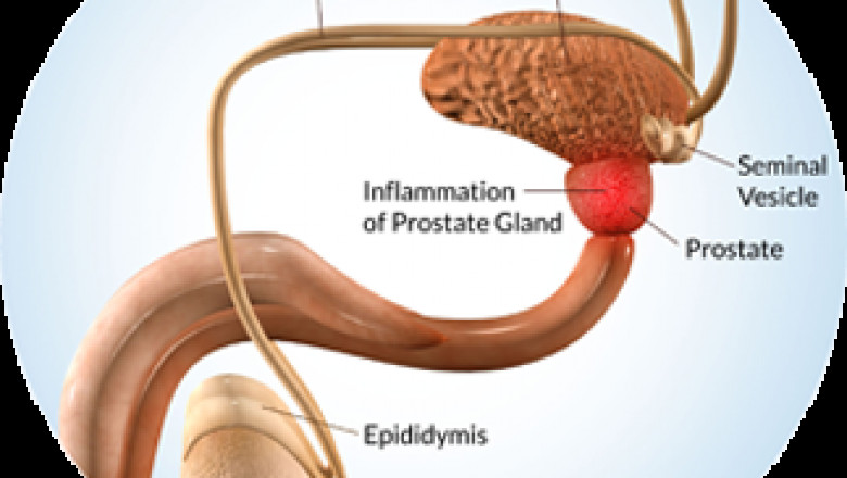BPH (Benign Prostate Hyperplasia): Understanding &amp; Treatments