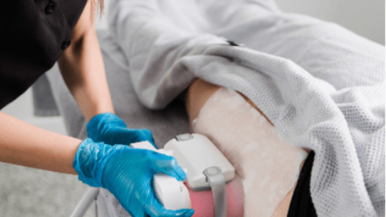 CoolSculpting for a Toned Appearance