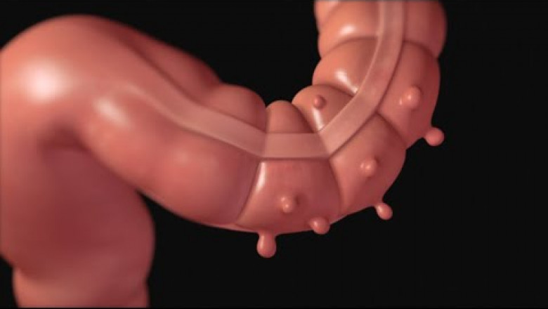 Diverticulitis Market Set to Surge with AI-Powered Diagnostics