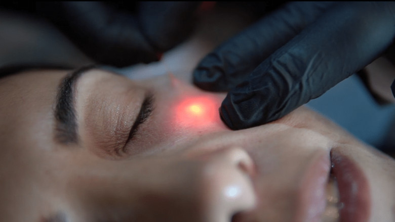 Endolift before and after results
