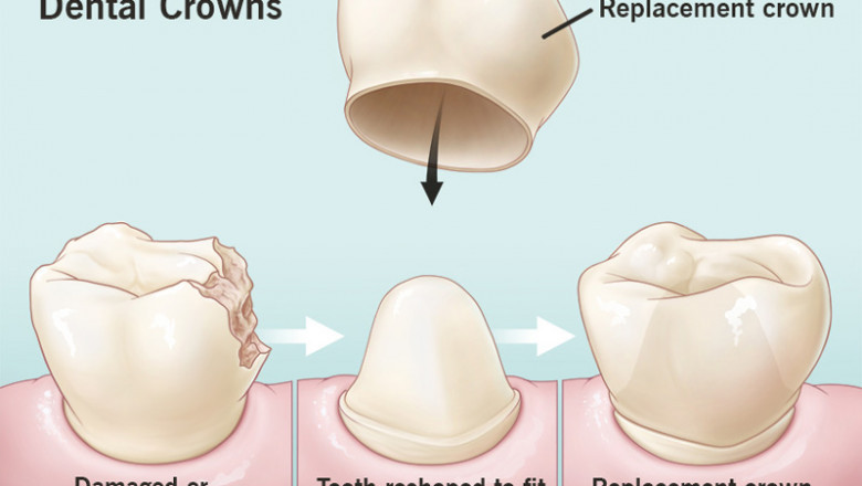 Expert dental crown for cracked tooth services