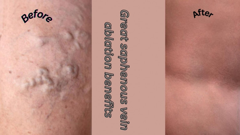 Great Saphenous Vein Ablation Benefits