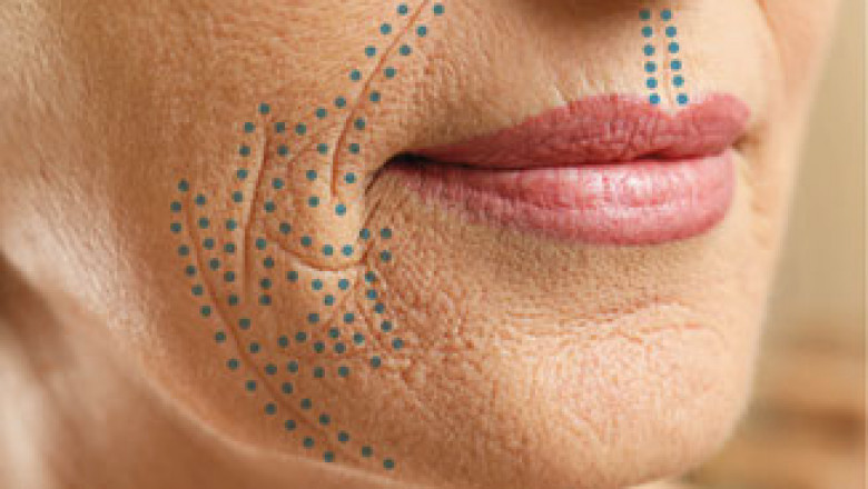 Plasma Pen Under-Eye Treatment in Dubai