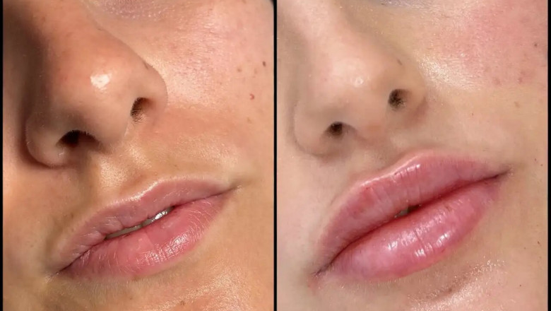 The Latest Trends from the Best Doctors in dubai for Fillers