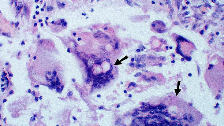 Blastomycosis Treatment Market Will Grow at Highest Pace Owing to Novel Antifungal Therapies