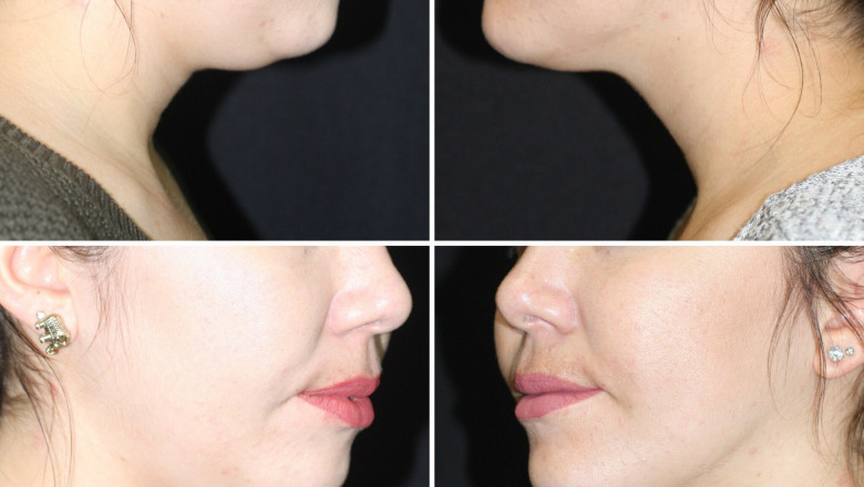 Double Chin Liposuction Explained