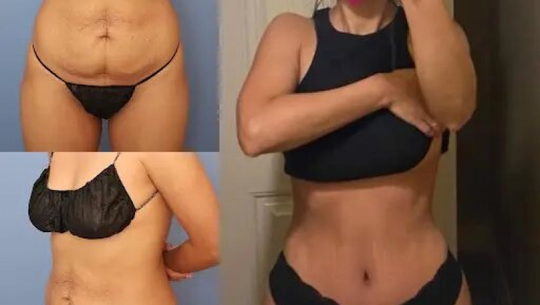 Dubai’s Standards of Excellence in Tummy Tuck Surgery in dubai