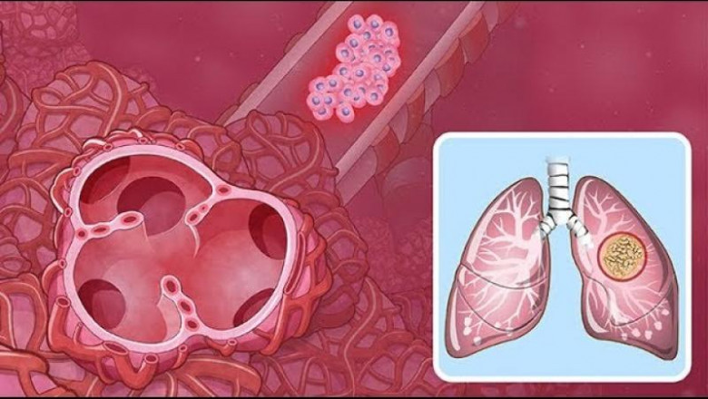 EGFR Non-Small Cell Lung Cancer Market to Soar with Biomarker-Driven Targeted Therapies