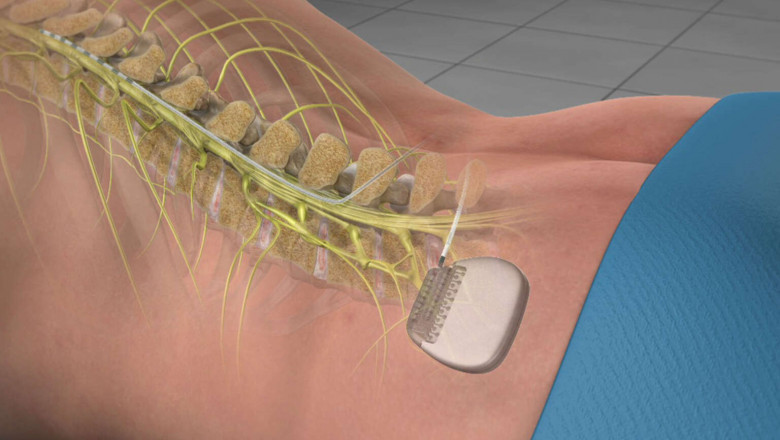 Exploring the Advancements and Benefits of Spinal Non Fusion Devices