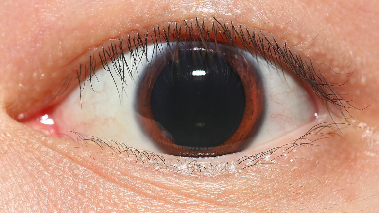 Mydriasis Treatment Market Witnesses High Growth Owing to Rising Ocular Disorders
