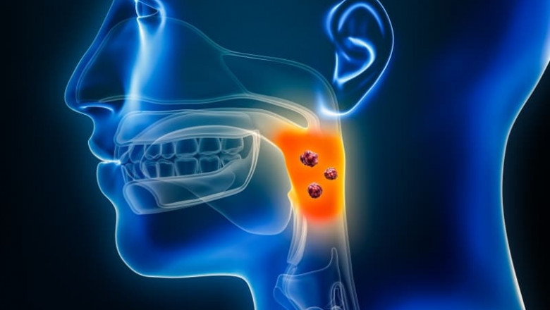 Nasopharyngeal Cancer Market Set to Surge on Immunotherapy Advancements