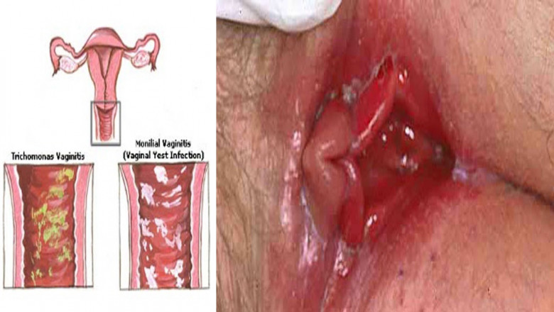Yeast Infection - Homeopathic Treatment in Philadelphia PA