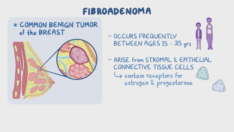 Fibroadenoma of the Breast - Philadelphia Homeopathic Clinic