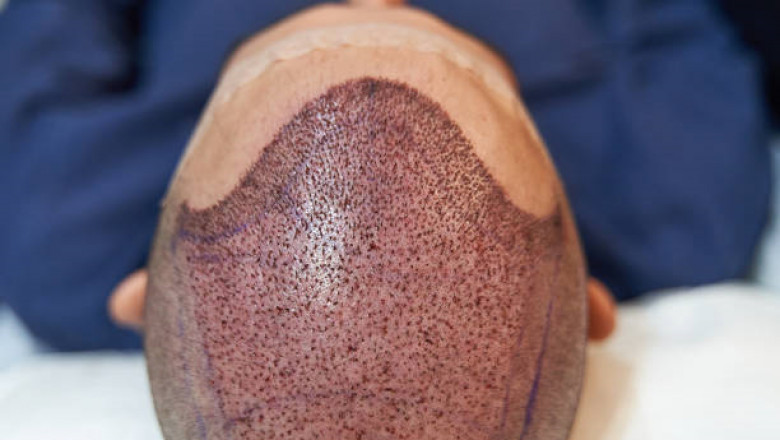 الفرق بين زراعة الشعر الطبيعي وتقنيات أخرى في الرياض