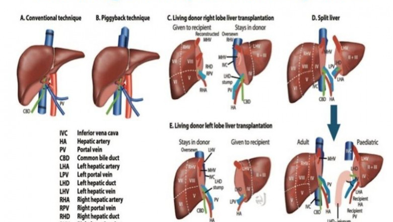 Liver Transplant &amp; Surgery in Bangalore – Trusted Care by Dr. Bhushan Chittawadagi