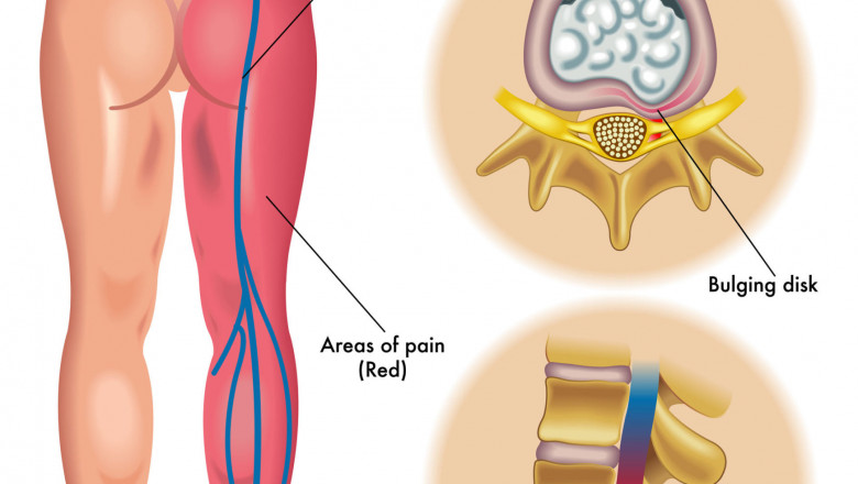 Natural Treatment for Sciatica - by Dr. Tsan and associates