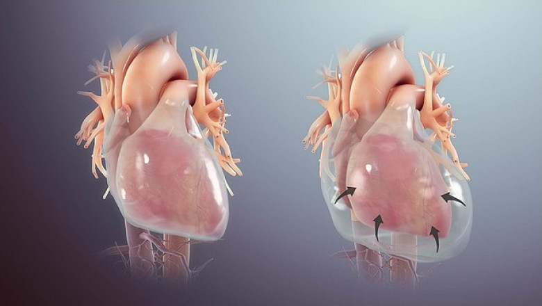 Recurrent Pericarditis Market to Grow on Rising Cardiac Disease Prevalence