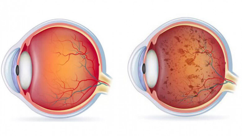 Retinitis Pigmentosa Market Anticipated to Grow Owing to Gene Therapy Advances