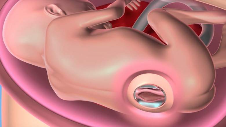 Spina Bifida In-Utero Market Poised for Growth Owing to Fetal Surgery Innovations