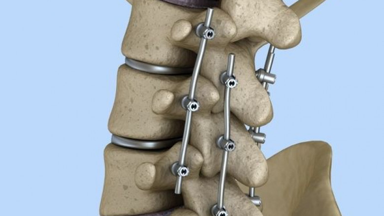Spinal Osteosynthesis Units Market Set to Surge on Rising Surgical Demand