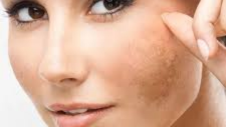 The Growing Popularity of Cryotherapy for Skin Health