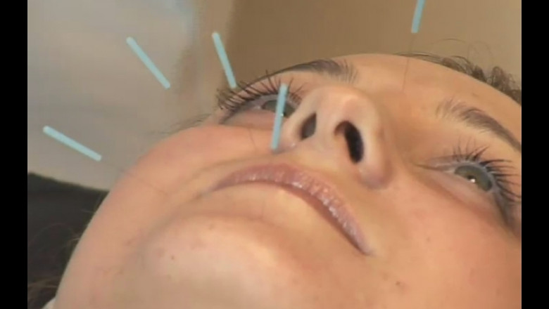 Trigeminal Neuralgia: Acupuncture Treatment in Philadelphia