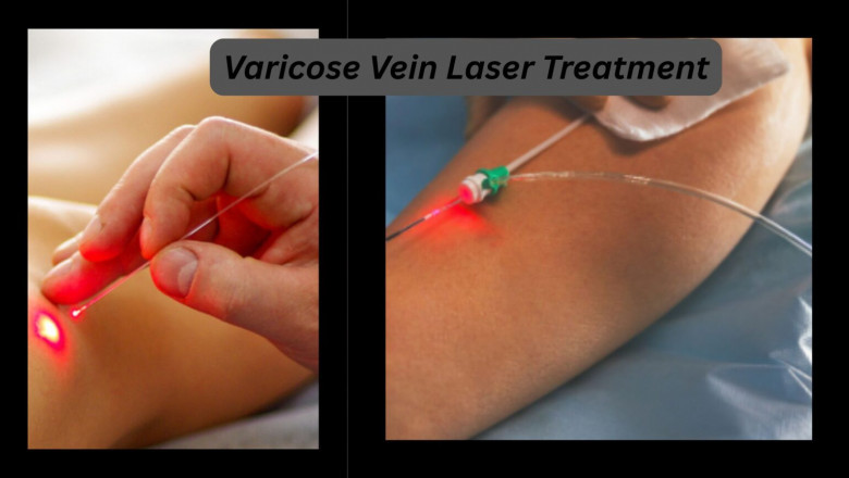 When Is Varicose Vein Laser Treatment Recommended?