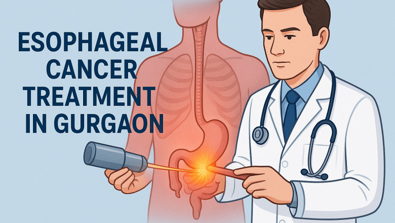 Esophageal Cancer: Early Signs, Diagnosis & Treatment Options in Gurgaon