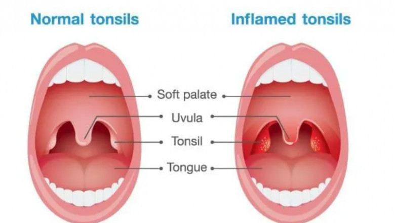 Natural Treatment of Tonsillitis