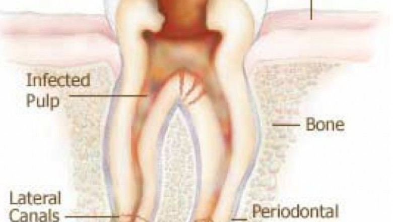 Abscess Treatment Market is Estimated to Grow Owing to Advanced Drainage Techniques