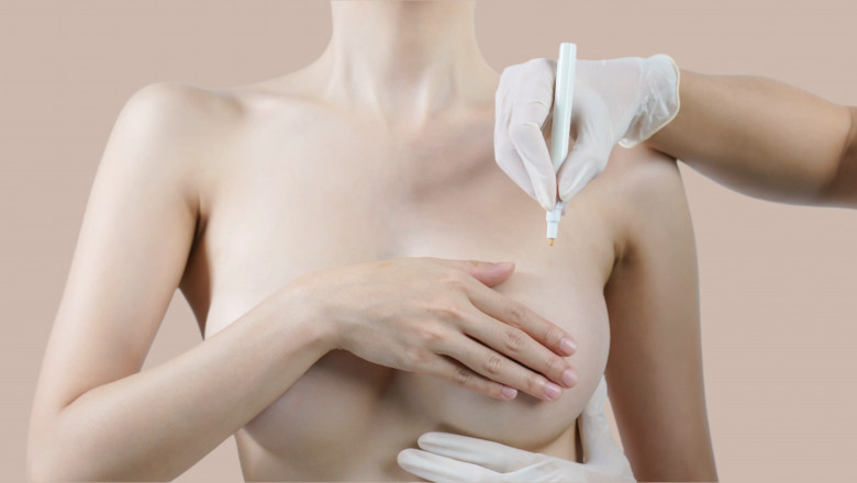 Breast Reduction in Dubai: A Guide to the Procedure and Recovery