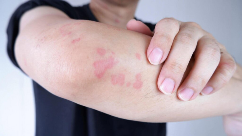 From Resistance to Remission: Innovations Revolutionizing Skin Infection Therapies
