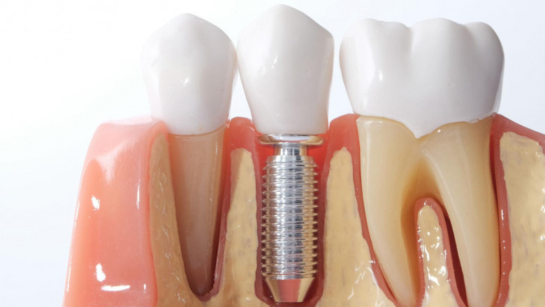Smile Big Again with the Confidence of Advanced Dental Implants