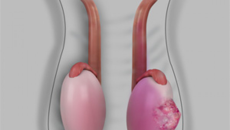 Testicular Cancer Drugs Market Estimated to Witness Growth Owing to Precision Medicine