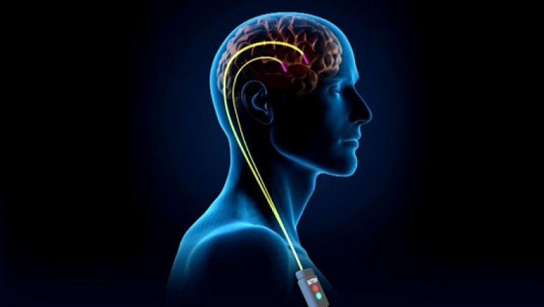 The Global Deep Brain Stimulation Devices Market: Outlook and Analysis