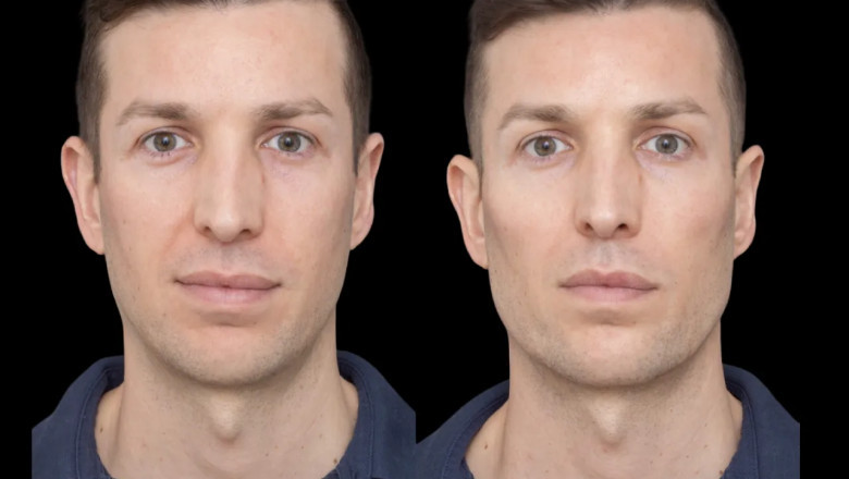 The Most Popular Filler Brands Used by the Best Plastic Surgeons in Dubai for Cheek Fillers