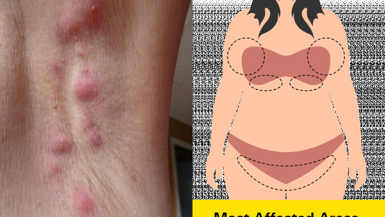 Therapeutic Breakthroughs in Hidradenitis Suppurativa: Market Drivers and Growth Outlook