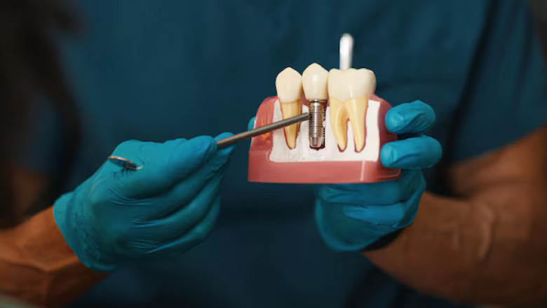 Dental Implants - Long-Lasting and Natural-Looking Solution for Those Missing Teeth