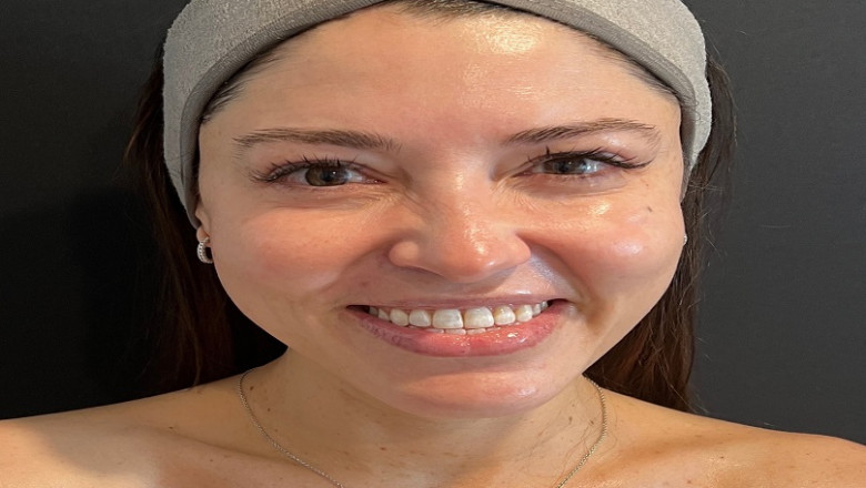 Hydrafacial for Acne-Prone Skin in Islamabad